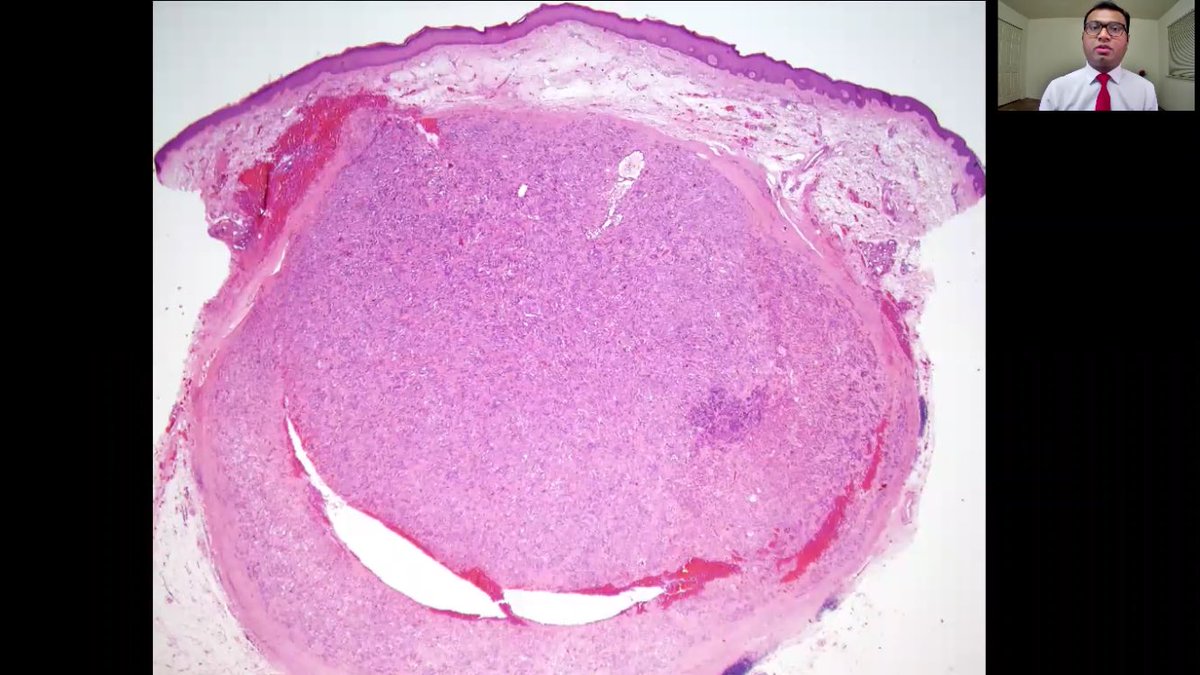 MitulModiMD's tweet photo. #ASDP20 #Collaboration #IstheKey #1 Feel free to check out this recently described entity @ASDPTweets abstracts/duel! Biggest shout out to @MightyDermPath for this wonderful opportunity! Humbled! @JMGardnerMD @RosNazarianMD @ProfRScolyerMIA @AadilAhmedMD https://t.co/C4bfE3oPpY