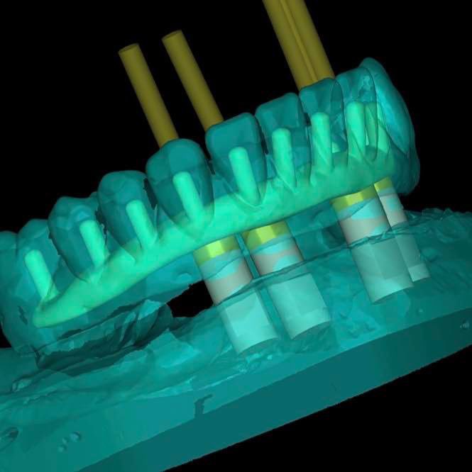 LabExcellence's tweet photo. #CadCam #digitaldentistry #dental #exocad https://t.co/wd5LyGOn6Q