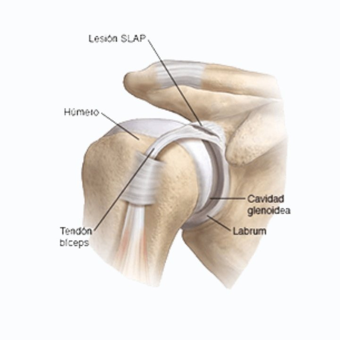 Slap повреждение плечевого. Slap синдром плечевого сустава мрт. суставной губы плечевого сустава. Slap повреждение. повреждение суставной губы плечевого сустава типы.