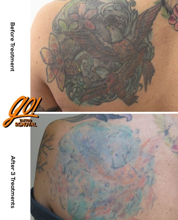 Removery  Formerly GO Tattoo Removal  Part 1 of 3 This huge project was  brought to us by a collector who had started tattoo removal elsewhere but  sadly they are no
