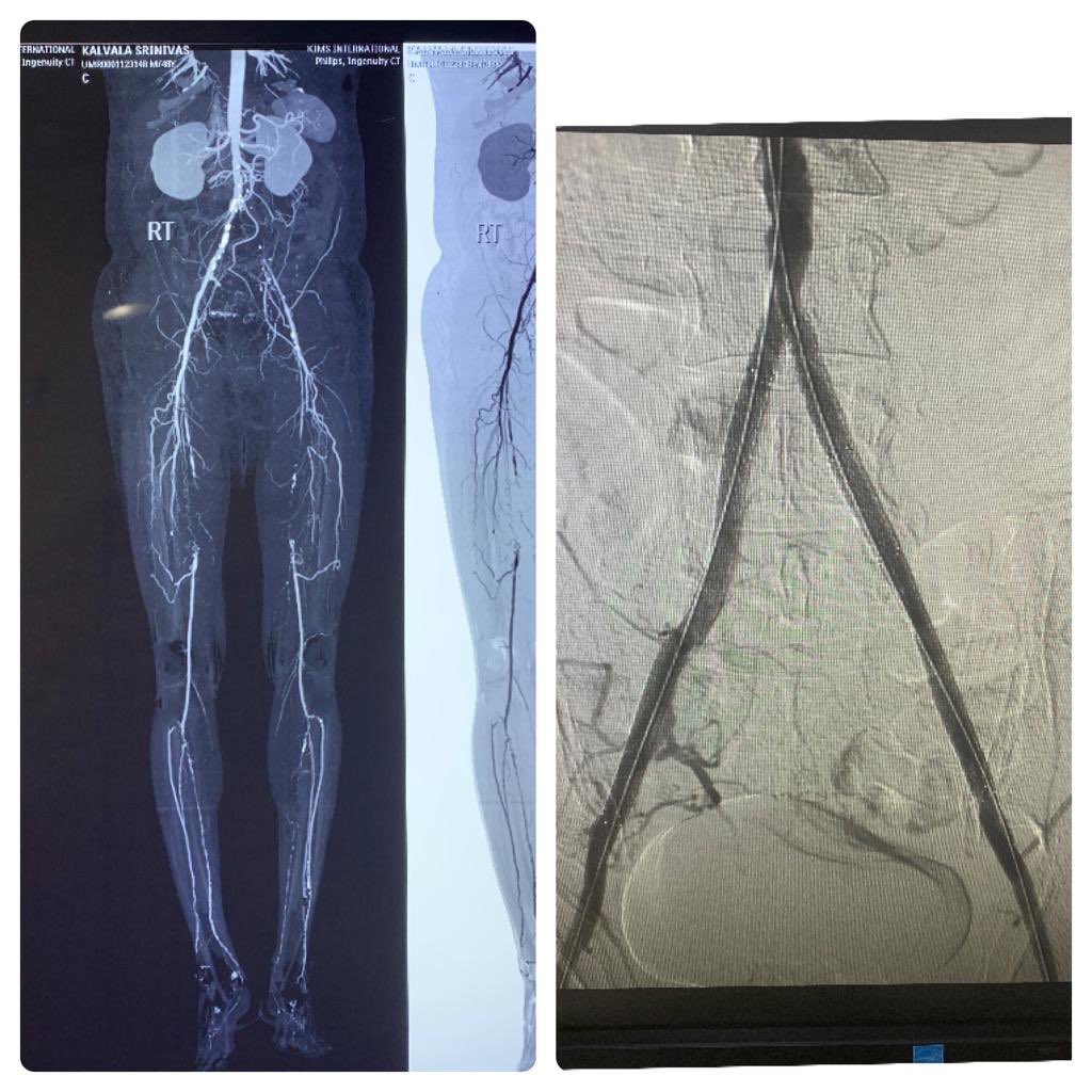 DSiddapuram's tweet photo. A 48 yrs old male with diabetes, social drinker and non smoker presented with C/o B/L lower limb claudication (L>R)since 2 years .he underwent B/L CIA +EIA stenting and now patient has palpable B/L femoral https://t.co/zEOL4lsSme