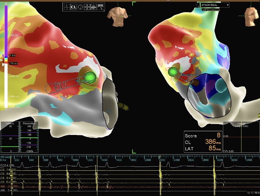 Margaret Boyette Kleiber (@buckboykleib) on Twitter photo #HDGrid helped us find Atach coming from near tricuspid valve annulus in healthy 40 year old woman...beautiful QS pattern and 6 seconds of RF with #flexibility .... & POOF
<a href="/NilssonEP/">Kent Nilsson, MD</a> <a href="/justintimeGA/">Justin Barnette</a> <a href="/AbbottCardio/">Abbott Cardiovascular</a> #HDGrid helped us find Atach coming from near tricuspid valve annulus in healthy 40 year old woman...beautiful QS pattern and 6 seconds of RF with #flexibility .... & POOF
<a href="/NilssonEP/">Kent Nilsson, MD</a> <a href="/justintimeGA/">Justin Barnette</a> <a href="/AbbottCardio/">Abbott Cardiovascular</a>