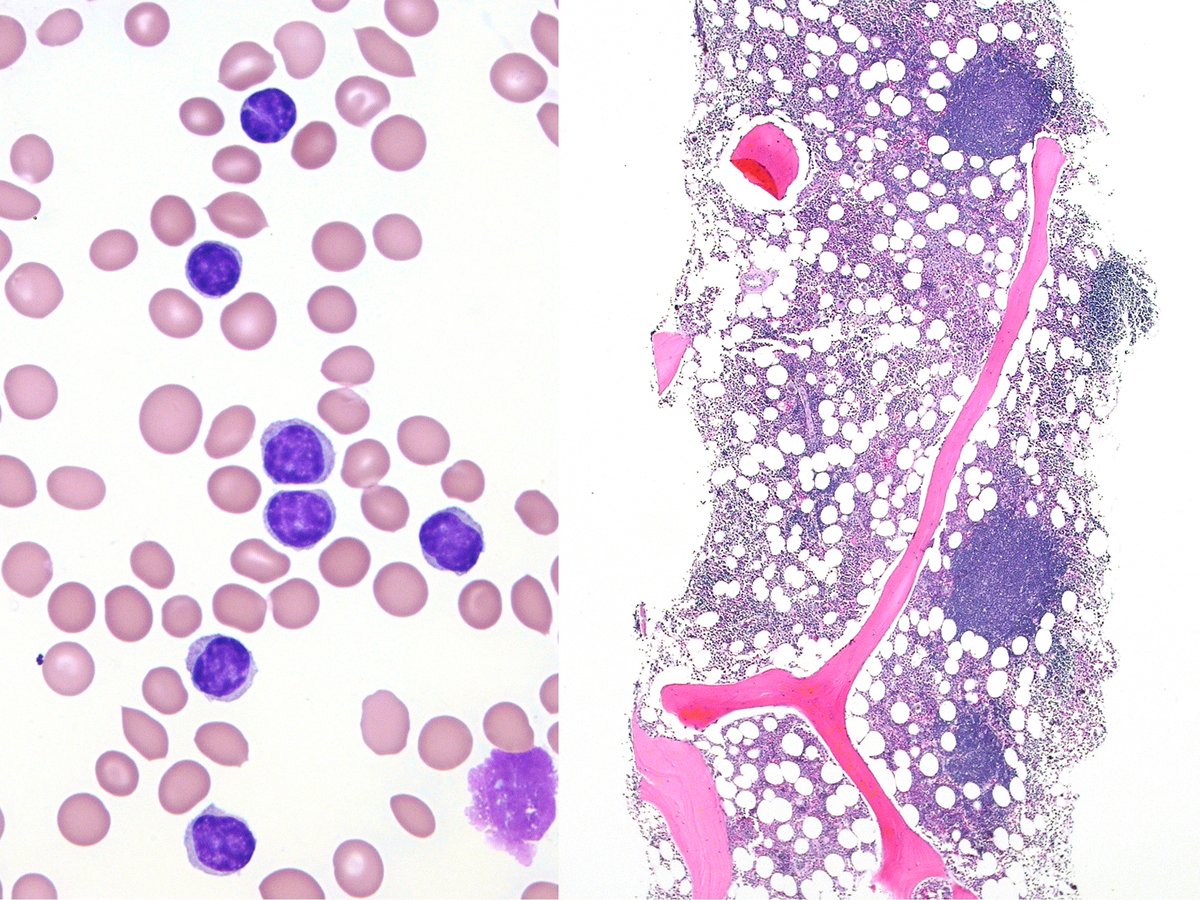 CLL - PB and marrow with nodular aggregates