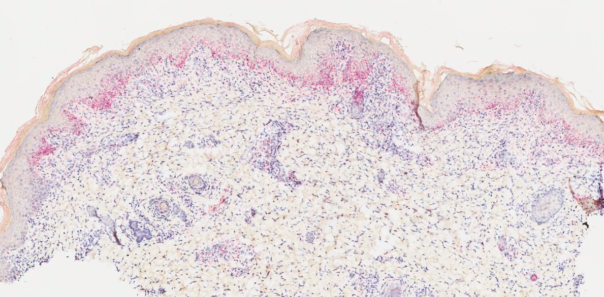 HENRYY_MD's tweet image. another great case of neonatal syphilis, almost signed out as Neonatal lupus. (ANA positive)
#pedipath #dermpath #ASDP20