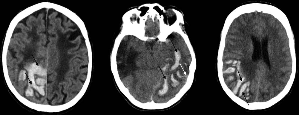 StrokeAHA_ASA's tweet photo. Sensitivity of the Edinburgh Criteria for Lobar Intracerebral Hemorrhage in Hereditary Cerebral Amyloid Angiopathy #ICH #stroke #AHAJournals https://t.co/kyMHHDqSsD
Also, check out #Editorial, Cerebral Amyloid Angiopathy: Still a Syndromal Diagnosis https://t.co/n9iiZTVTqB https://t.co/IaFUPBtrZE