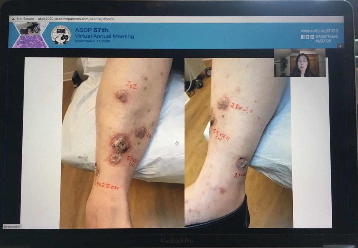 Dermpathl's tweet image. These keratoacanthoma-like squamous proliferations in a patient on pembrolizumab (diagnosed as “squamous cell carcinoma” on biopsy) showed marked improvement with topical &amp;amp; intralesional steroids. - case presented by Dr Jennifer Choi at #ASDP20 #dermpath #pathology #dermatology