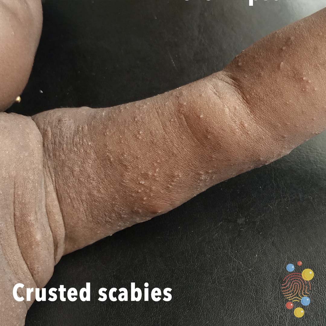DFTBSkinDeep's tweet photo. Have you seen crusted scabies?

This image shows extensive papular eruption on upper limbs with thick crust affecting the trunk.

https://t.co/BozNzlDDxP
Want to join us? hello@dftbskindeep.com
#skindeep#FOAMed #dermatology#diversity#MedEd @rcpch_trainees @PemTrainingUK @PEMSoC https://t.co/r2y9sWC6rP
