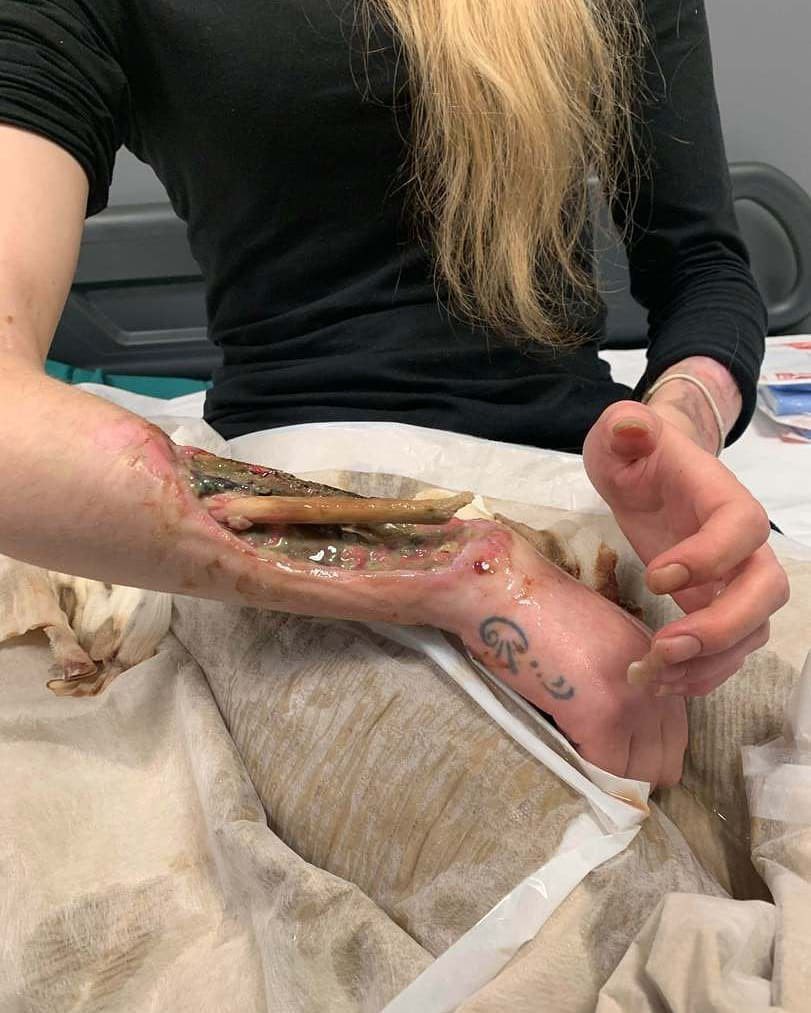 OurFavOnlineDoc's tweet photo. Necrosis is death of body tissue. It happens when too little blood flows to the tissue. This can be from chemicals.

This lady’s hand has now developed necrosis from years of injecting herself with drugs to get high and feel good.

Just incase nobody ever told you.
Pass this on. https://t.co/iCPv8S5eCP