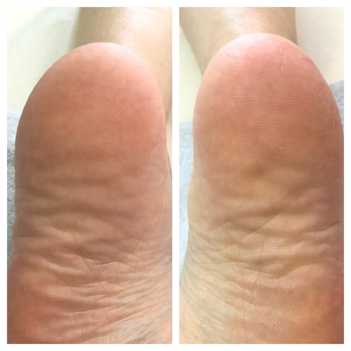 フットケア Tokotoko 劇的ビフォーアフター これから冬にかけて クリーム塗っても全然 という人に是非ともやってほしいフットケア 保湿力が全っったく違って快適ですよ ドイツ式フットケア 角質ケア かかとのひび割れ 京都 西院