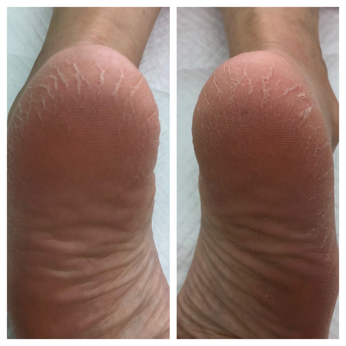 フットケア Tokotoko בטוויטר 劇的ビフォーアフター これから冬にかけて クリーム塗っても全然 という人に是非ともやってほしいフットケア 保湿力が全っったく違って快適ですよ ドイツ式フットケア 角質ケア かかとのひび割れ 京都 西院