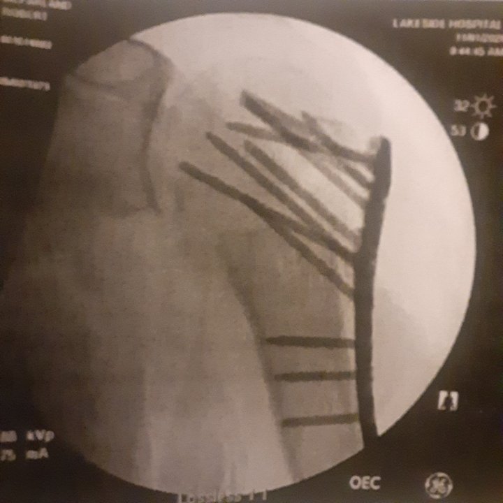 brianmcfa's tweet photo. I'd just celebrated 20 years in #LawEnforcement last month. Last week, a domestic disturbance and a suspect that didn't want to be handcuffed pretty much destroyed my shoulder when we ended up in a pile on the floor. Suspect still went to jail, not sure when I'll work again. https://t.co/7iOe2h0ztM
