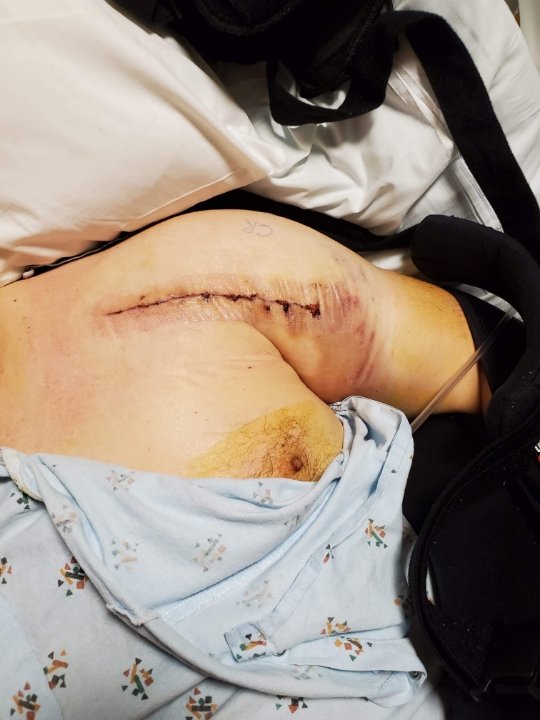 brianmcfa's tweet photo. I'd just celebrated 20 years in #LawEnforcement last month. Last week, a domestic disturbance and a suspect that didn't want to be handcuffed pretty much destroyed my shoulder when we ended up in a pile on the floor. Suspect still went to jail, not sure when I'll work again. https://t.co/7iOe2h0ztM