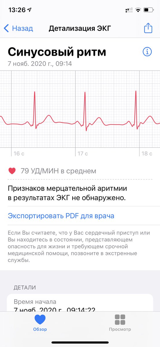 Заработало ЭКГ на Apple Watch, теперь электрокардиограф всегда с собой!) #ЭКГ #электрокардиограмма #Apple #AppleWatch #new #ecg