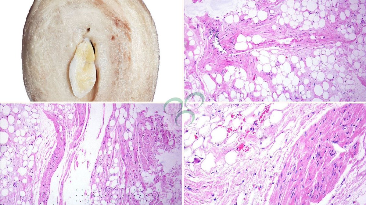 GeronimoJrLapac's tweet image. A nice uterine lipoleiomyoma.
#gynpath #pathology