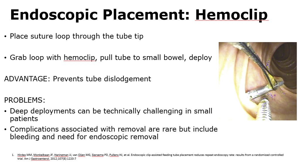 molivahemker's tweet image. @ColumbiaMed Dr. Ali Mencin&apos;s gives options for placement of nasogastric &amp;amp; postpyloric feedings tubes. 
#NASPGHAN20 #GITwitter #PedsGITwitter