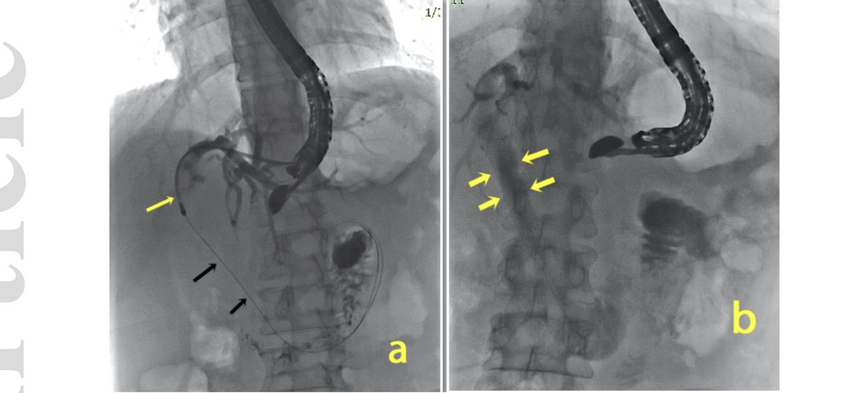 GauravMuktesh's tweet photo. A case of paraduodenal pancreatitis with triple obstruction (biliary stricture, duodenal stenosis and pancreatic stricture) underwent successful eus guided biliary drainage and eus guided pancreatic drainage. Doing well. 
#eusbd #euspd #pancreatitis #digestiveendoscopy https://t.co/iheC9AwKbh