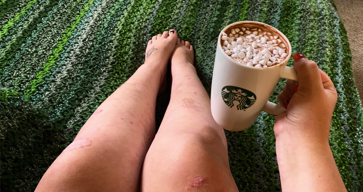 Samantha12Sue's tweet photo. π« #HotCocoa #HotChocolate #SwissMiss #MarshmallowLovers #Starbucks #PositivelyPrimitive #crochet #blanket #yarn #psoriasis #PsoriaticArthritis #PsoriasisAwareness #AutoImmuneDisease https://t.co/62b82H9vik