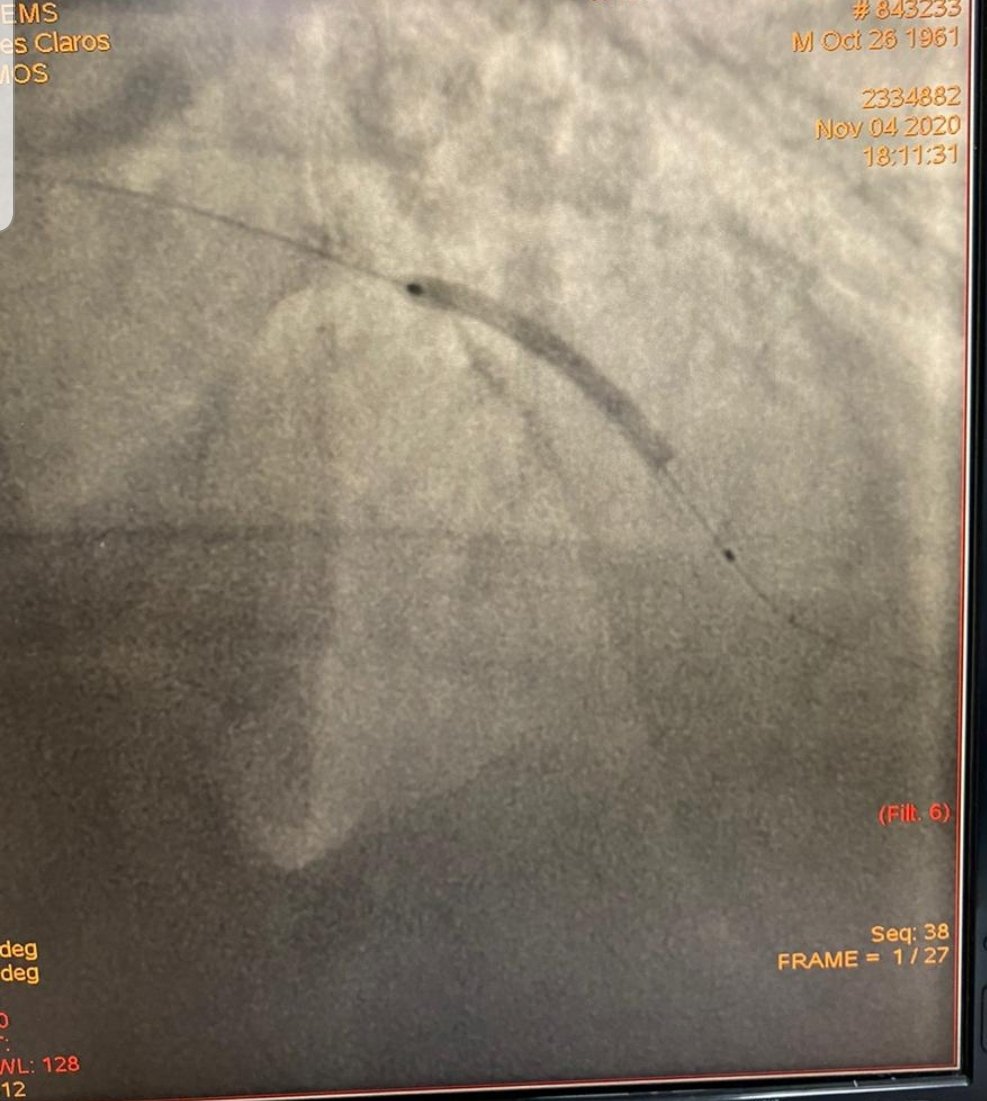 profHenderson's tweet photo. Realizado angioplastia com implante de stent farmacológico e uso de Tirofiban (inibifor da GP IIb-IIIa) https://t.co/zTp4SboJdy