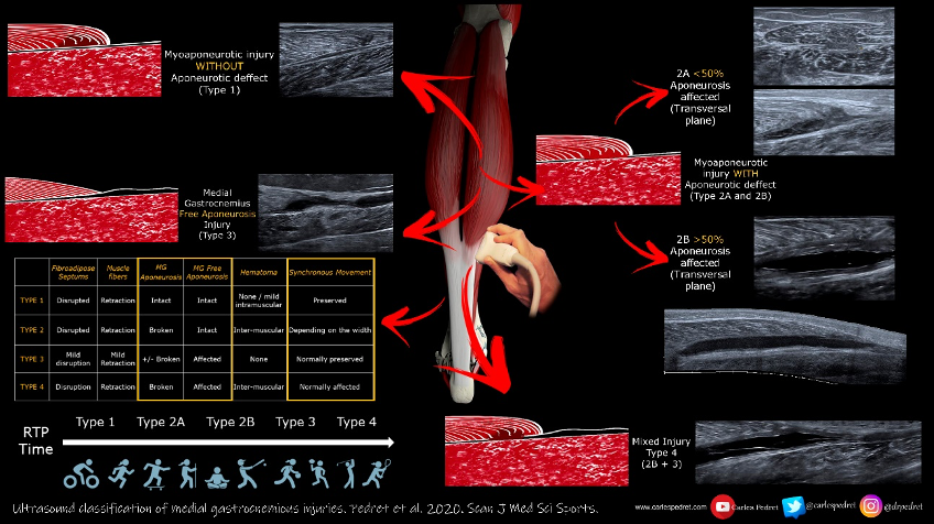 BJSM_BMJ's tweet photo. 750 views within 6-hours of going online! Will this go down as a BJSM blog classic?

Medial Gastrocnemious Tears In Sports: Is It About Muscle, Aponeurosis Or Tendon? (and does it even matter!?)

👏@carlespedret #MSK #CalfInjuries  

https://t.co/t42oj6K6Ou https://t.co/ZoF5KTMced