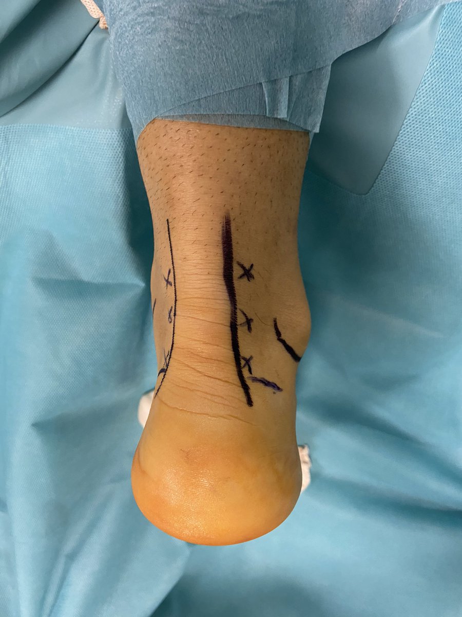 davidbarastegui's tweet photo. Siempre intento marcar estructuras y referencias anatómicas antes de las cirugías. Detalle de las puertas posteriores del tobillo, según la zona a tratar puedes variar su altura, siempre vigilando el nervio sural #orthotwitter #arthroscopy #footandankle @aeartroscopia https://t.co/qH2LOs80IV