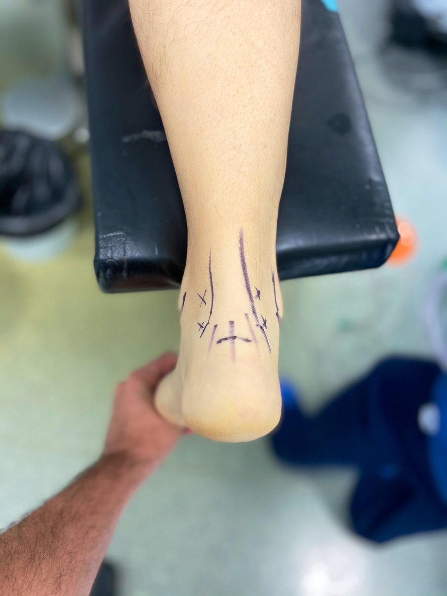 davidbarastegui's tweet photo. Siempre intento marcar estructuras y referencias anatómicas antes de las cirugías. Detalle de las puertas posteriores del tobillo, según la zona a tratar puedes variar su altura, siempre vigilando el nervio sural #orthotwitter #arthroscopy #footandankle @aeartroscopia https://t.co/qH2LOs80IV