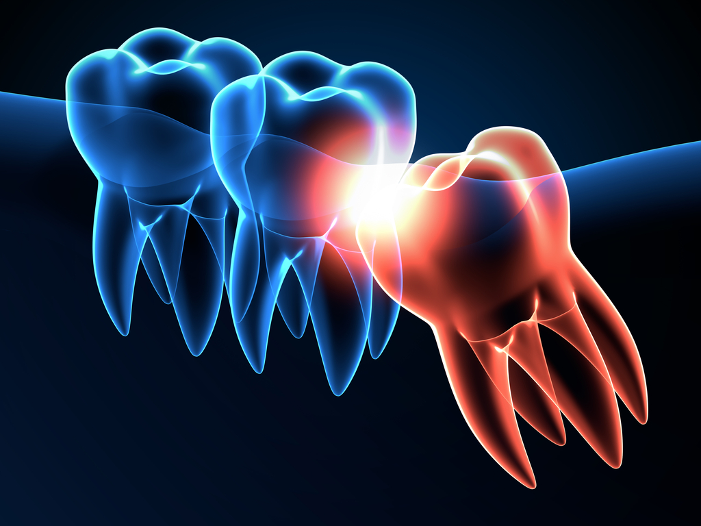 TXOSS's tweet photo. Wisdom Teeth History
If you’ve ever wondered why wisdom teeth (the third set of molars) develop only to be removed, you’re not alone.  #wisdomteeth #wisdomteethextraction #wisdomteethGrapevine https://t.co/rjCs4SkR8o https://t.co/iPHtitB8yT