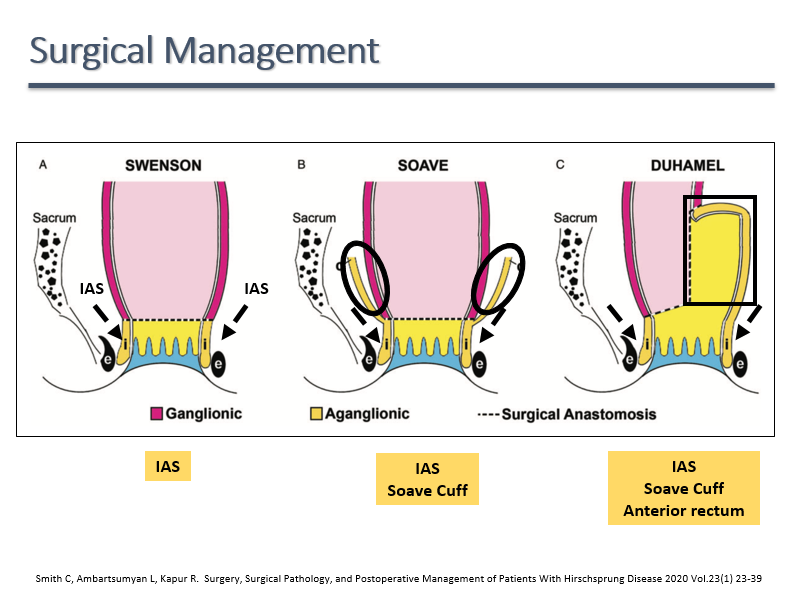 molivahemker's tweet image. @seattlechildren Dr. Lusine Ambartsumyan provides excellent information on managing children after their surgery for Hirschsprung&apos;s disease or anorectal malformations. #NASPGHAN20 Postgrad course #GITwitter #pedsgitwitter