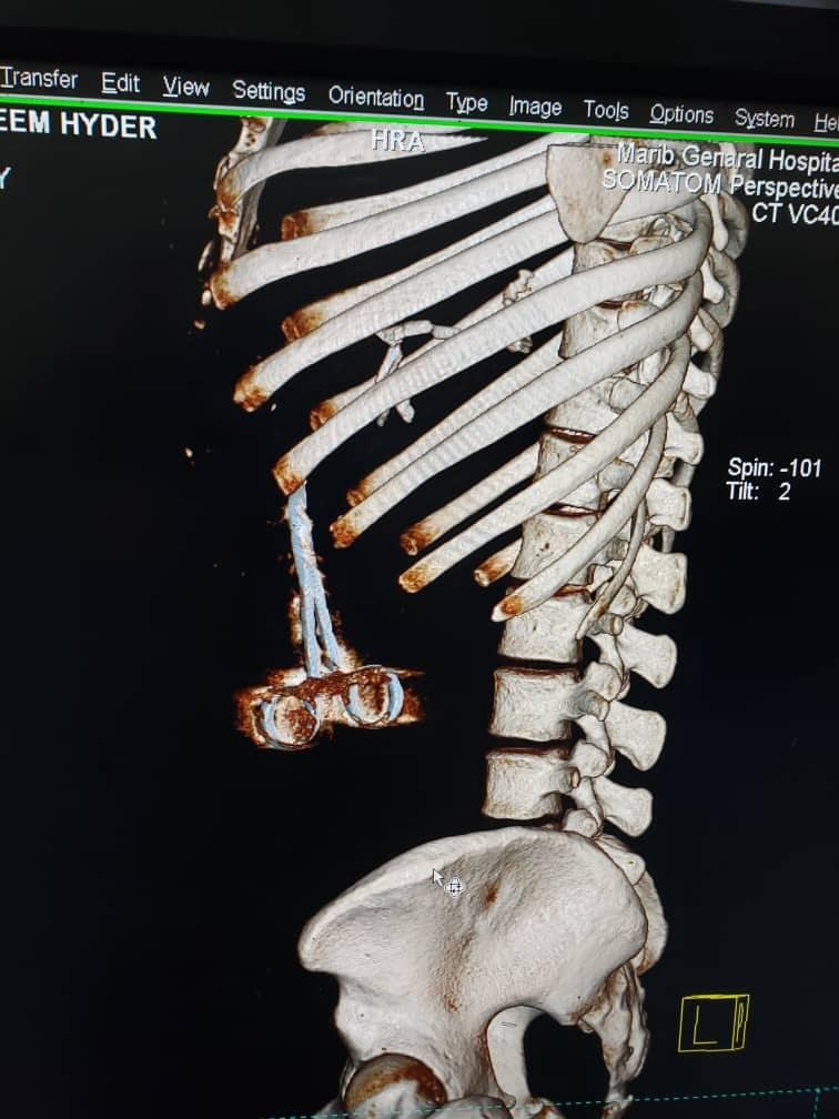الاشعة المقطعية تظهر المقص داخل جسم الجريح