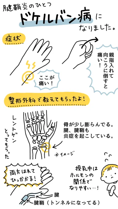 手が痛くて1ヶ月治らなかったので整形外科に…やっぱりドケルバン病(腱鞘炎)でした⚡
対処法等教えてもらって楽になってきた気がするので、同じく痛んでる方へ、よくなりますように!✨

育児、スマホなどでなりやすいようです? 