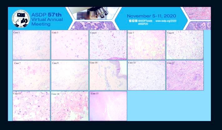 DrSimonLamothe's tweet image. Great Fellow Presentation on the subject of atypical pleomorphic fibrolipomatous tumors by Dr. Laleh Montaser Kouhsari! @llmontaseri at #ASDP2020 Representing @BIDMCpath and #ucsfpath