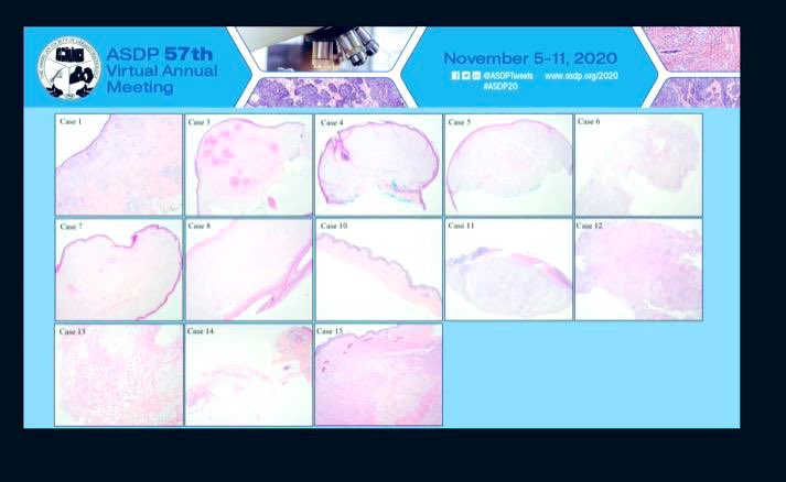 DrSimonLamothe's tweet image. Great Fellow Presentation on the subject of atypical pleomorphic fibrolipomatous tumors by Dr. Laleh Montaser Kouhsari! @llmontaseri at #ASDP2020 Representing @BIDMCpath and #ucsfpath