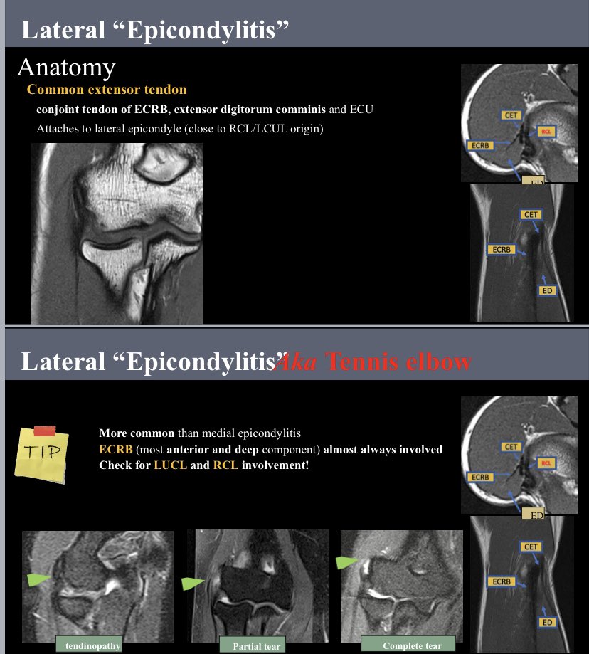Medial vs lateral epicondylitis. 
Quick MRI anatomy & tips to remember #radresidents #msk #radiology #MSKRad #orthotwitter #radres #FOAMrad