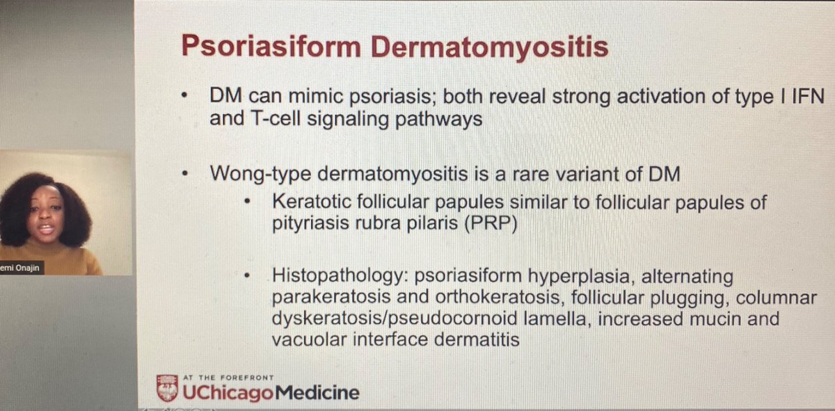 AAlhatem_MD's tweet image. Psoriasiform Dermatomyositis mimics Psoriasis. Same morphology but different treatment. Consider it in your DDx. CPC is always recommended from Dr Oluwakemi Onajin @ASDPTweets #asdp20