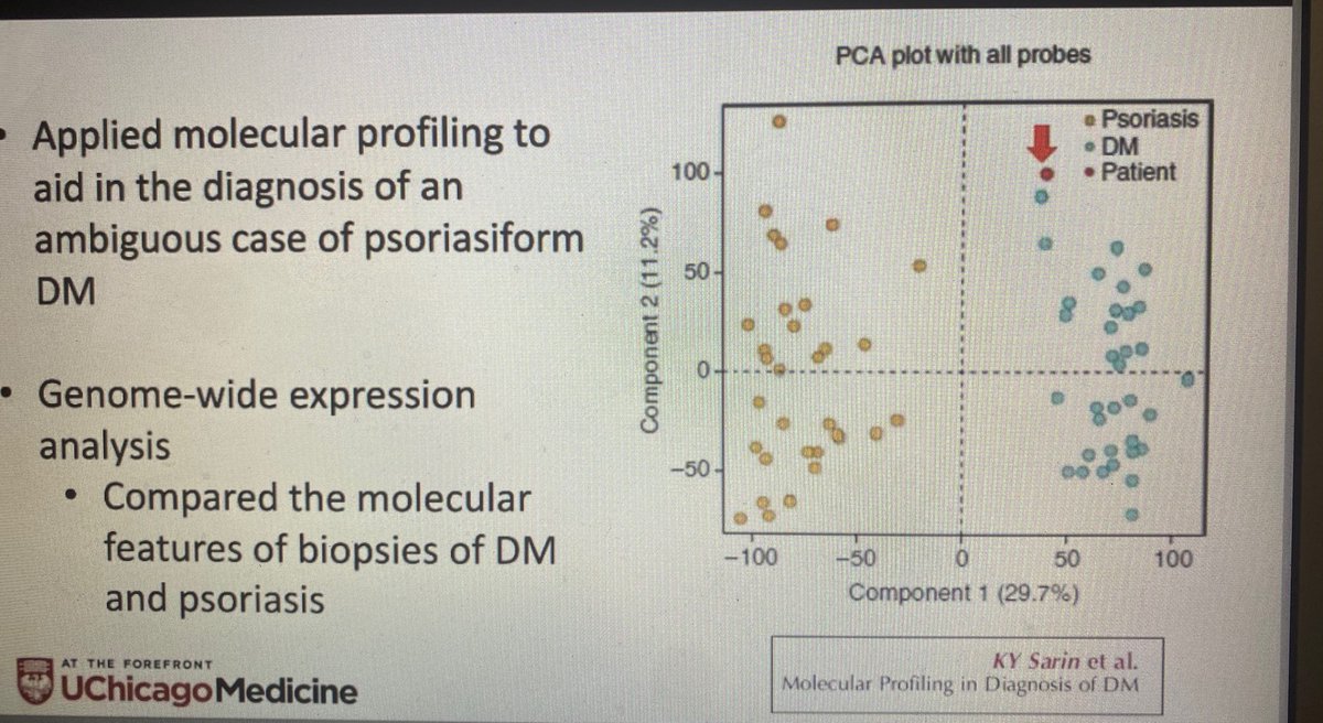 AAlhatem_MD's tweet image. Psoriasiform Dermatomyositis mimics Psoriasis. Same morphology but different treatment. Consider it in your DDx. CPC is always recommended from Dr Oluwakemi Onajin @ASDPTweets #asdp20