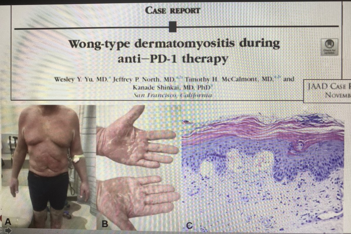 AAlhatem_MD's tweet image. Psoriasiform Dermatomyositis mimics Psoriasis. Same morphology but different treatment. Consider it in your DDx. CPC is always recommended from Dr Oluwakemi Onajin @ASDPTweets #asdp20