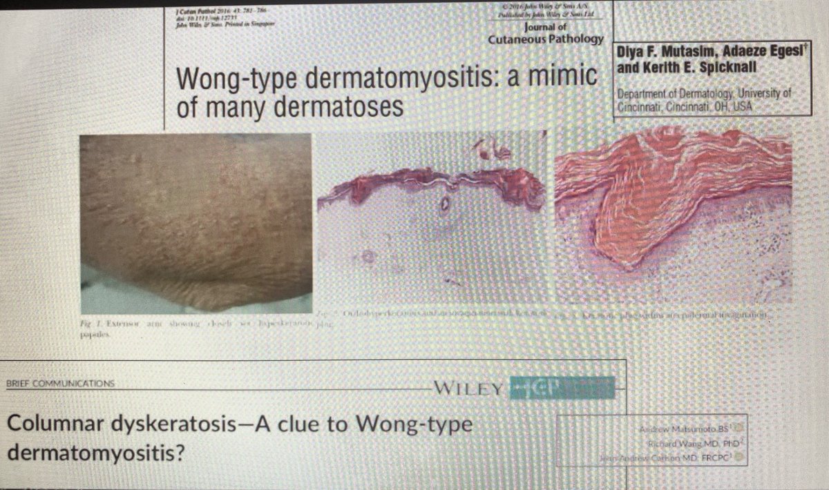 AAlhatem_MD's tweet image. Psoriasiform Dermatomyositis mimics Psoriasis. Same morphology but different treatment. Consider it in your DDx. CPC is always recommended from Dr Oluwakemi Onajin @ASDPTweets #asdp20