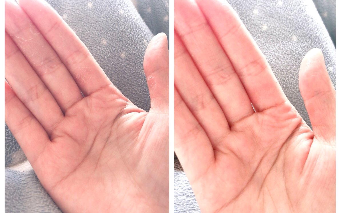Uzivatel マコ Na Twitteru ミルクもありますね お腹とか膝とか広範囲がカサカサしてるときはミルクが良いですよね 逆に手荒れしちゃったハンドクリームや 手荒れに滲みちゃうものもあったんですけど ロコベースどんなに荒れてても絶対滲みないのですきです