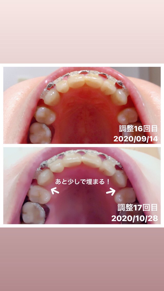 Haburashi 調整17回目 歯列矯正 変化です 抜歯跡ももうすぐ埋まる 歯列矯正 アンカースクリュー 口ゴボ ガミースマイル T Co as2omnye Twitter Haburashi 調整17回目 歯列矯正 変化です 抜歯跡ももうすぐ埋まる 歯列矯正 アンカースクリュー 口ゴボ ガミースマイル T Co as2omnye Twitter