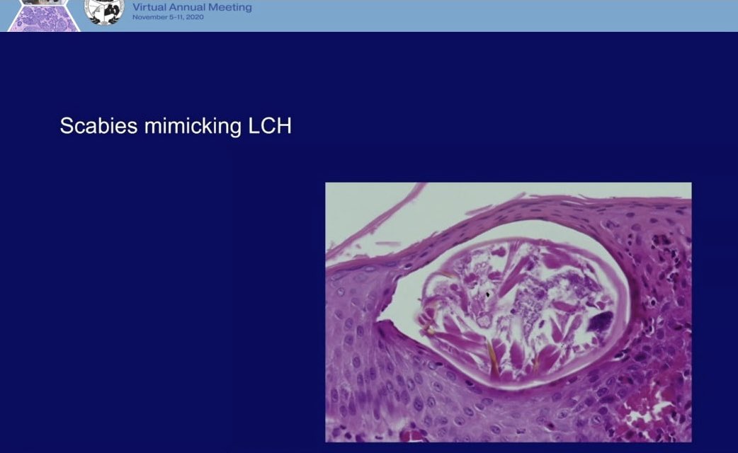 HENRYY_MD's tweet image. Another fantastic talk by the Great Elston! Cutaneous infections. #ASDP2020  #helwiglecture
The scary story of kid with diagnosis of LCH treated with alkylation agents turns out to be Scabies infestation 😱