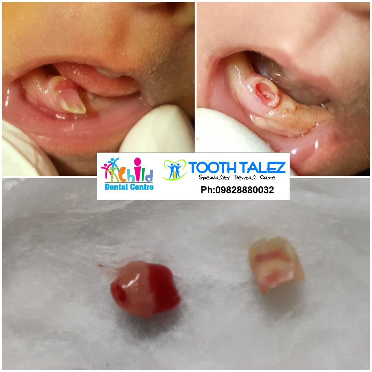 toothtalez's tweet photo. A ten day old also needs a Pediatric Dentist.Neonatal teeth is a common finding in children and not to be afraid of.#Dentist #Dentistinjaipur #Dentistforkids #Pediatricdentist #dentalcinic #natalteeth #neonatalteeth #babyteeth. https://t.co/wdYF82oiGl