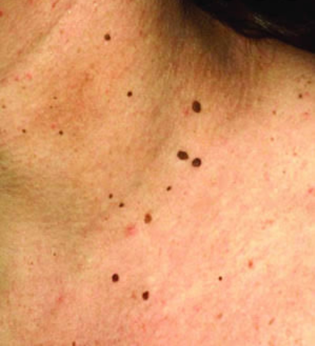 imederm's tweet photo. Los fibromas blandos aparecen en el cuello de todas las personas. Son muy comunes.
No son contagiosas ni se vuelven malas.
La causa es variada desde hereditarios hasta relacionado con el sobre peso.

https://t.co/cCNj4CJIWu 
#dermatologia #cdmx #imederm #dermatologo https://t.co/DCobS9cIpl