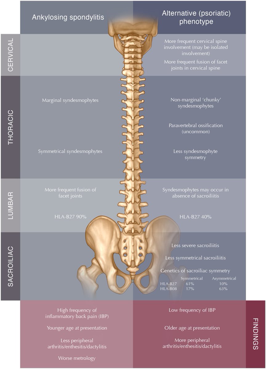 DerekGriffin86's tweet photo. Different phenotypes of axial disease involvement among patients with psoriatic arthritis versus ankylosing spondylitis. https://t.co/OyB843hYAR https://t.co/79LSI0SVOn