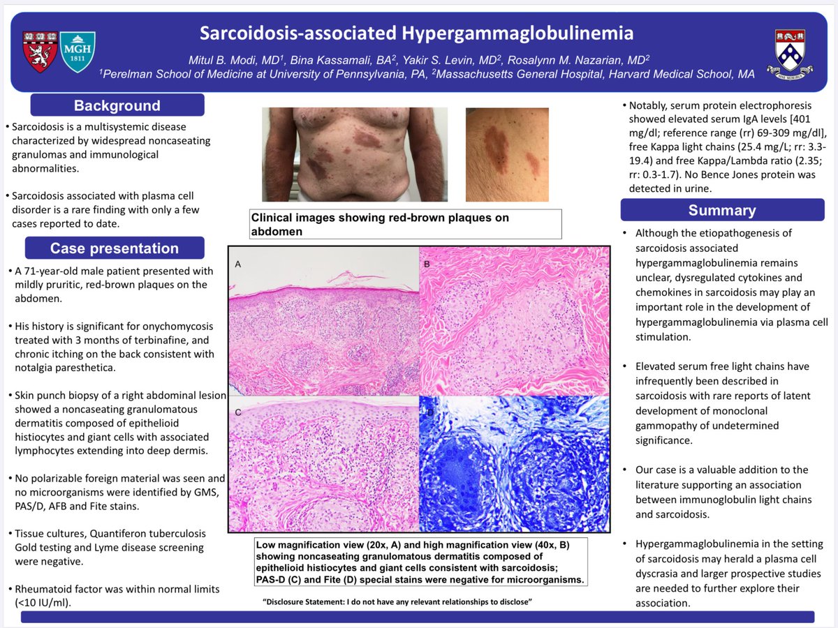 MitulModiMD's tweet photo. #ASDP2020 #Collaboration #IstheKey #2 Sarcoidosis associated hypergammaglobulinemia (plasma c dis) @ASDPTweets abstracts/poster193! By one &amp; only, the awesome @RosNazarianMD, thank you!🙏 link:https://t.co/G99H78HSIj @MGHPathology @bwhdermatology @PennMDForum https://t.co/JYU8G7qACC