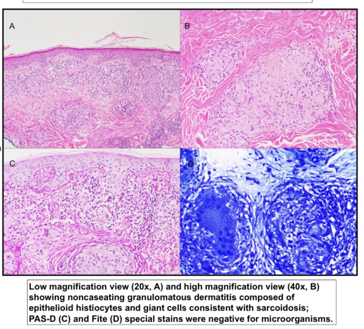 MitulModiMD's tweet photo. #ASDP2020 #Collaboration #IstheKey #2 Sarcoidosis associated hypergammaglobulinemia (plasma c dis) @ASDPTweets abstracts/poster193! By one &amp; only, the awesome @RosNazarianMD, thank you!🙏 link:https://t.co/G99H78HSIj @MGHPathology @bwhdermatology @PennMDForum https://t.co/JYU8G7qACC