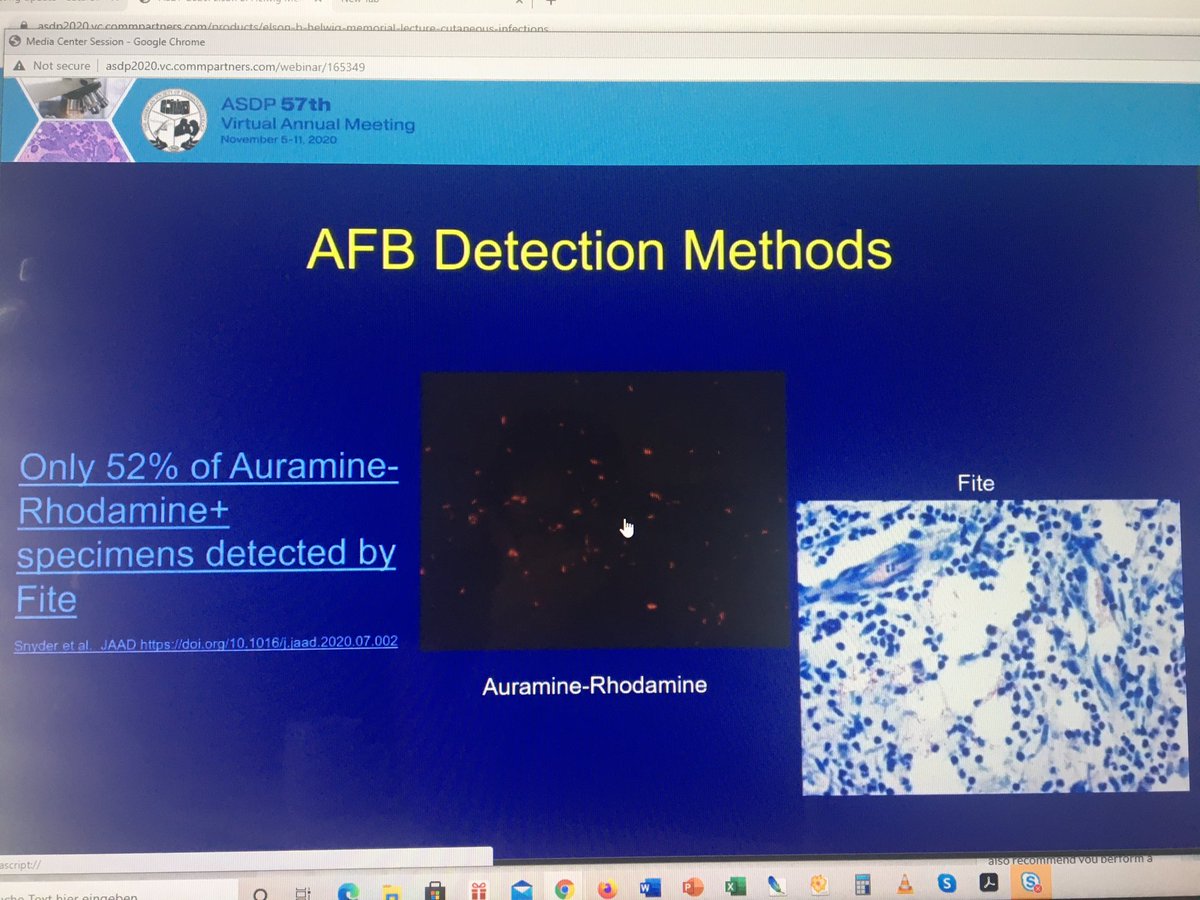 tonitatirado's tweet image. #dermpath #ASDP2020 If you’re not using Auramine-Rhodamine you are missing half of your cases    😳