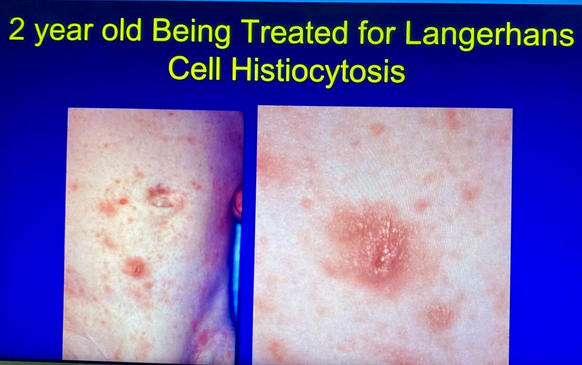 AAlhatem_MD's tweet image. Beware of scabies when you make LCH diagnosis. The patient was diagnosed in a prestigious US institution and treated with chemo till the correct diagnosis was rendered just at the time of a dermpath meeting. Dr Dirk Elston @ASDPTweets #ASDP20 #dermpath #dermatology