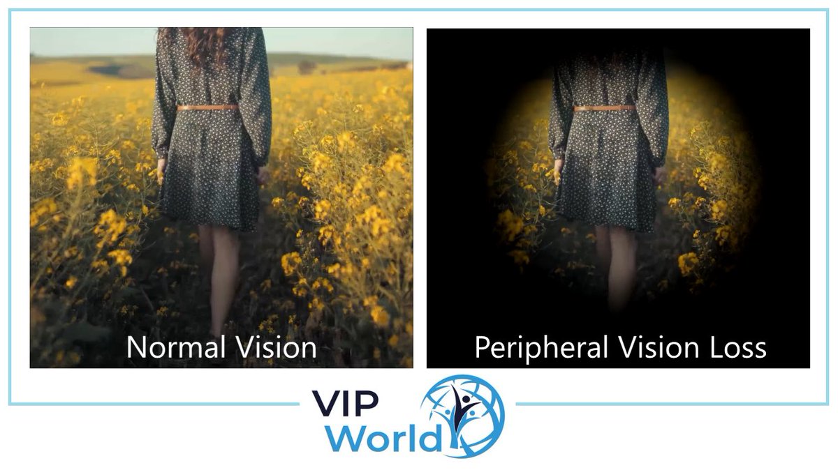 vipworldservice's tweet image. A Representation Of Some Common Forms Of Visual Impairment.
Peripheral Vision Loss- Central Vision tend to be clear, however side vision is unclear. Peripheral Vision Loss can cause issues with mobility and potentially reading speed. 
#VIPWorldServices #VisuallyImapired