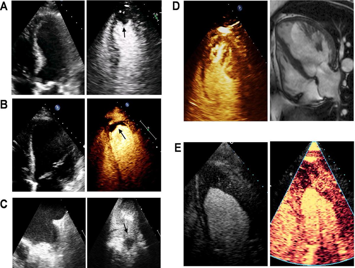 Heart_BMJ's tweet image. Really good article  on the application of Contrast Echo
heart.bmj.com/content/early/…