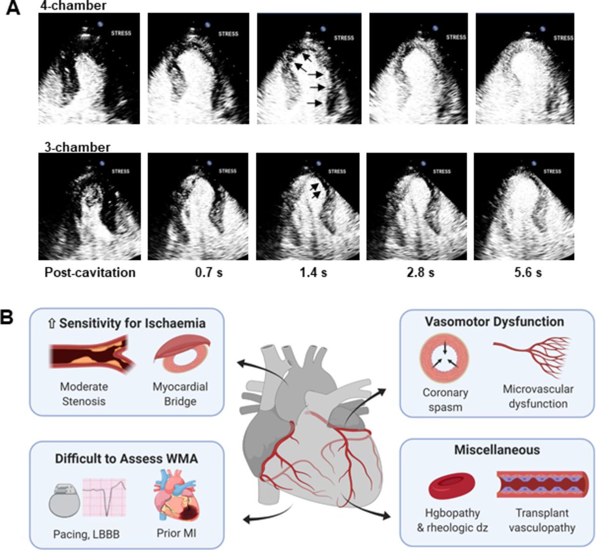 Heart_BMJ's tweet image. Really good article  on the application of Contrast Echo
heart.bmj.com/content/early/…