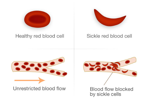 MpangevCOMM3724's tweet photo. Anemia is a condition in which you lack enough healthy red blood cells to carry adequate oxygen to your body's tissues. This condition was first discovered in 1910 in United States when an anemic patient's blood was examined and found with blood cells that had a "shape of sickle" https://t.co/GX91me4vBs
